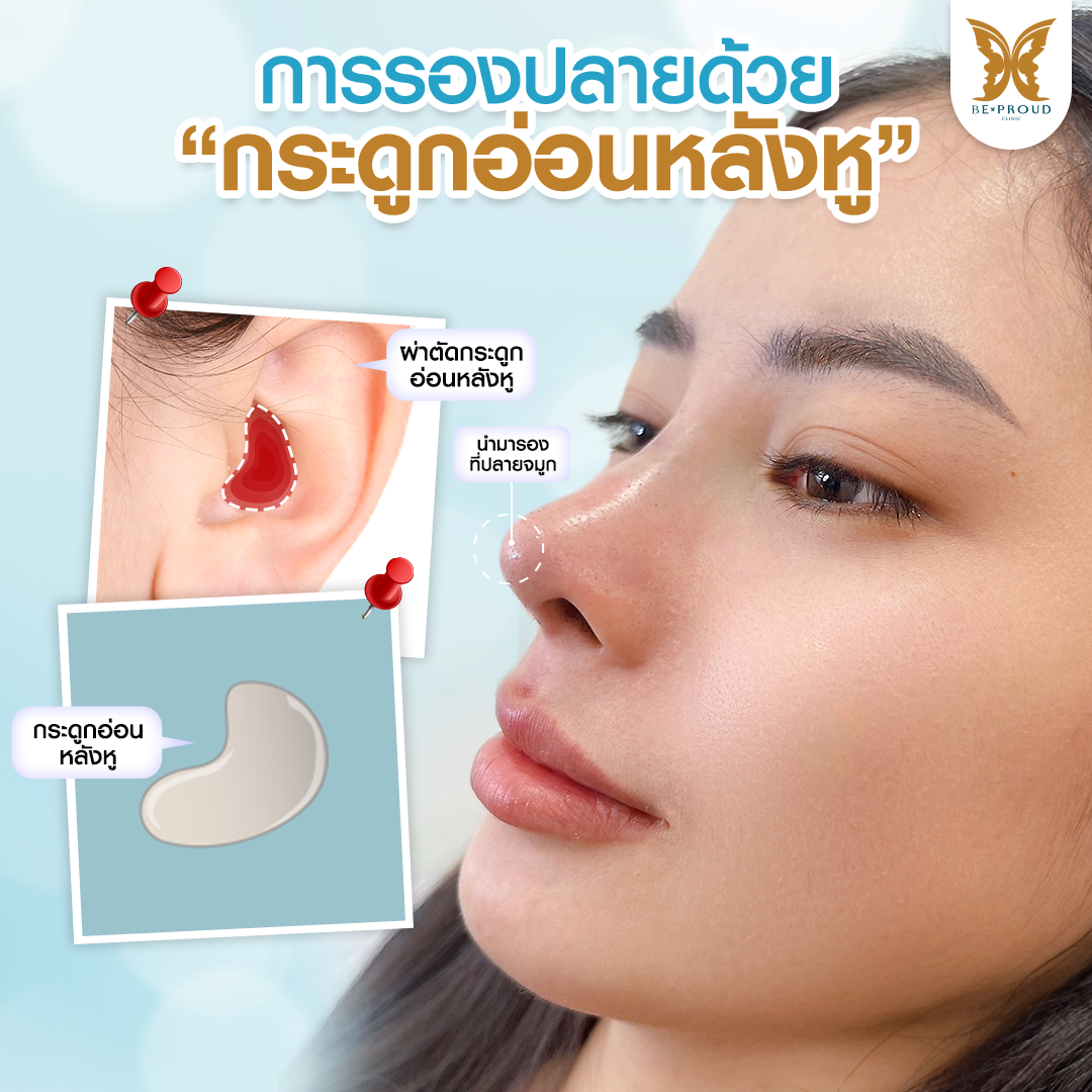 การรองปลายจมูกด้วยกระดูกอ่อนหลังหู