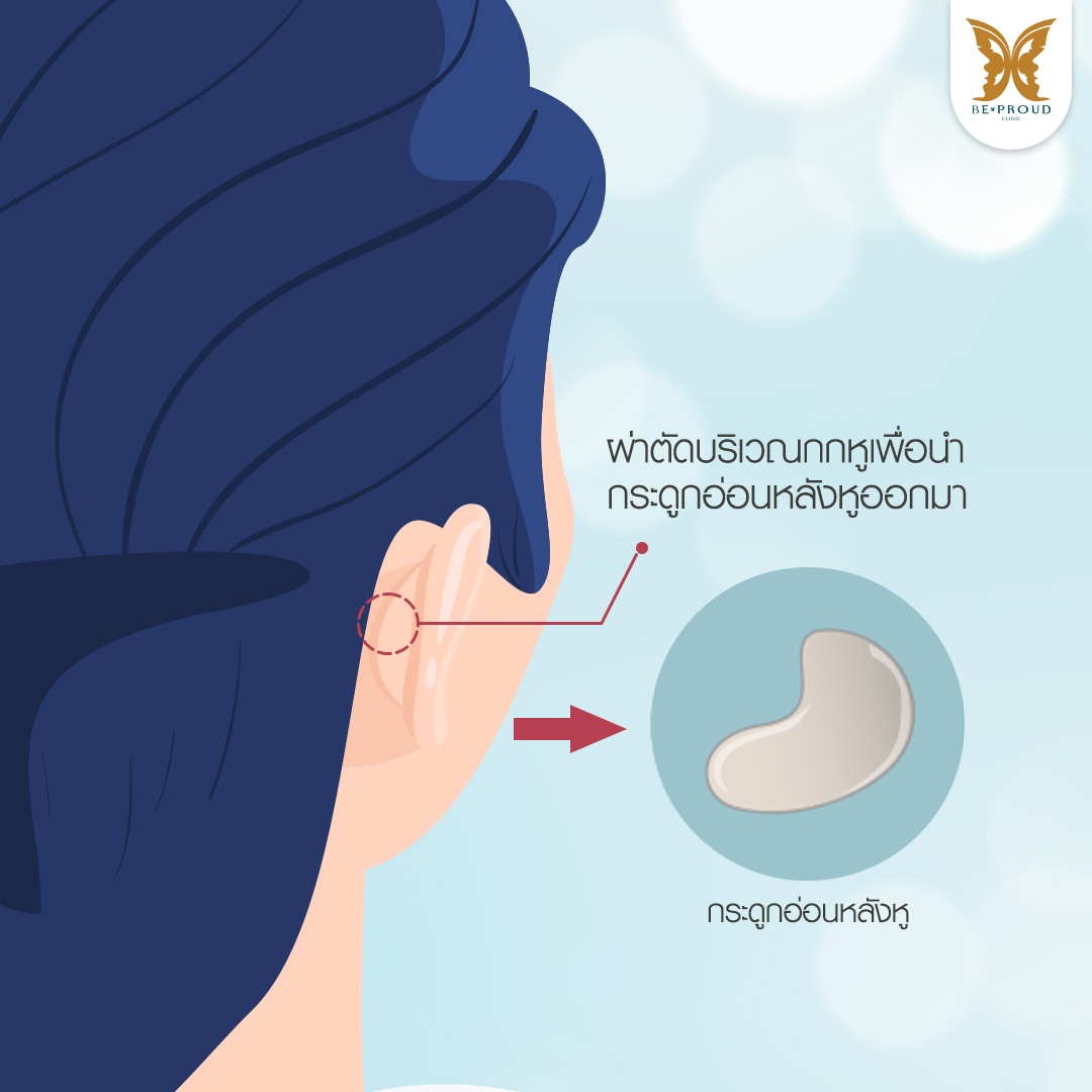 การรองปลายจมูกด้วยกระดูกอ่อนหลังหู