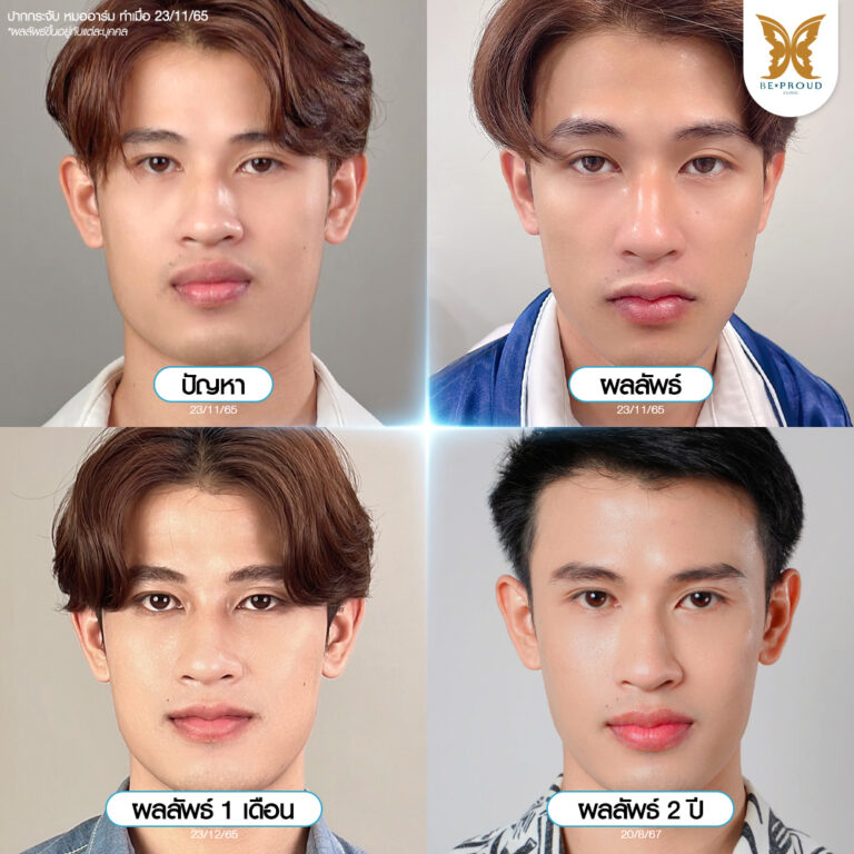 ปากกระจับผู้ชาย ก่อนทำหลังทำ