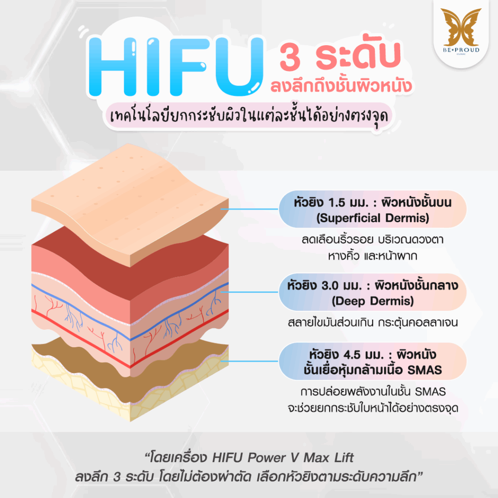 หัตถการปรับรูปหน้า ​HIFU