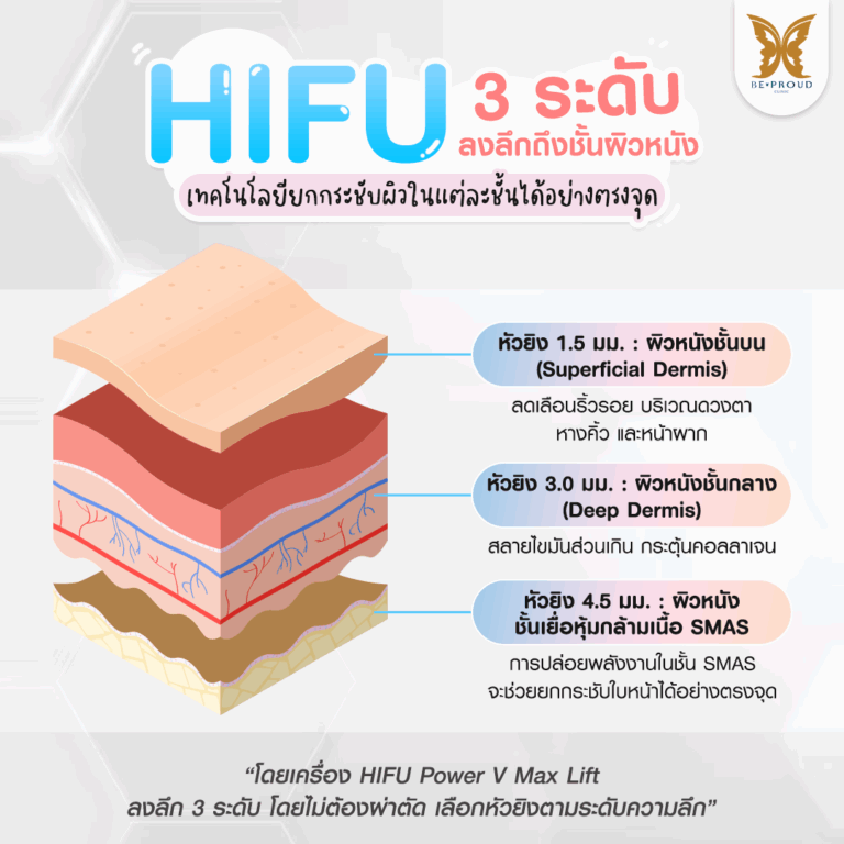 หัตถการปรับรูปหน้า ​HIFU