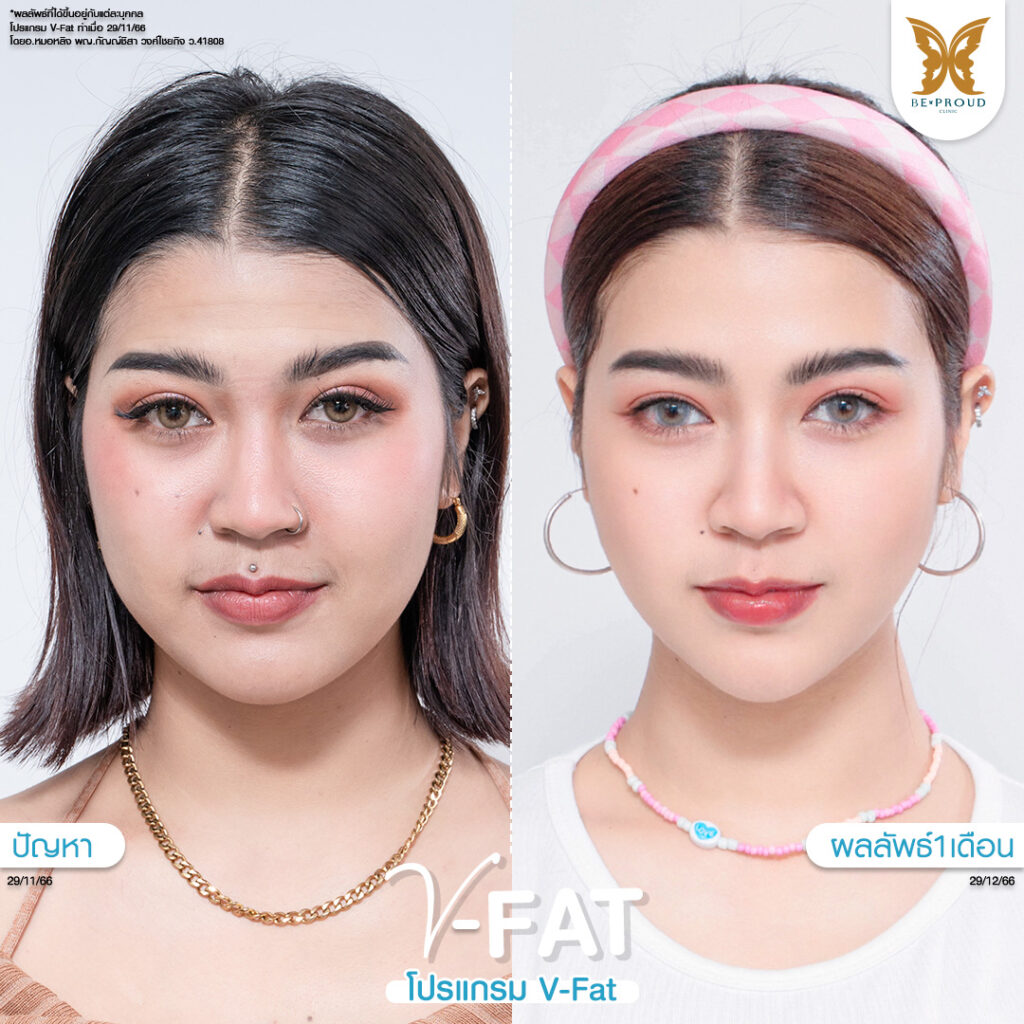 หัตถการปรับรูปหน้า​ V-Fat