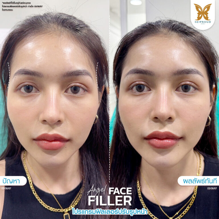 หัตถการฟิลเลอร์ปรับรูปหน้า บีพราวด์
