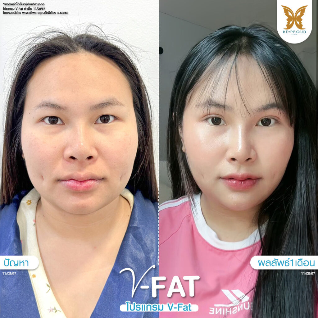 หัตถการปรับรูปหน้า​ V-Fat