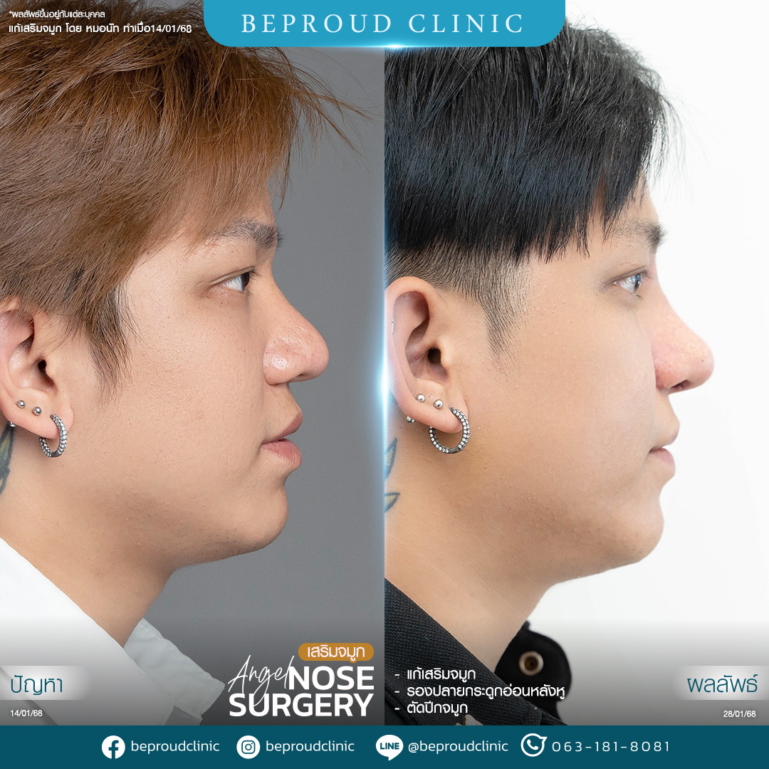 การรองปลายจมูกด้วยกระดูกอ่อนหลังหู