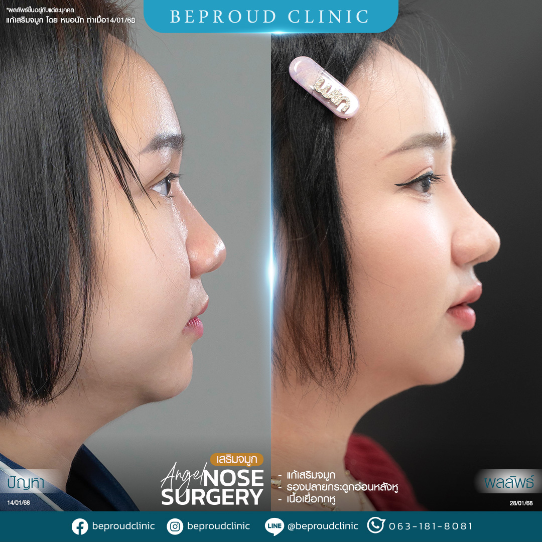 การรองปลายจมูกด้วยกระดูกอ่อนหลังหู