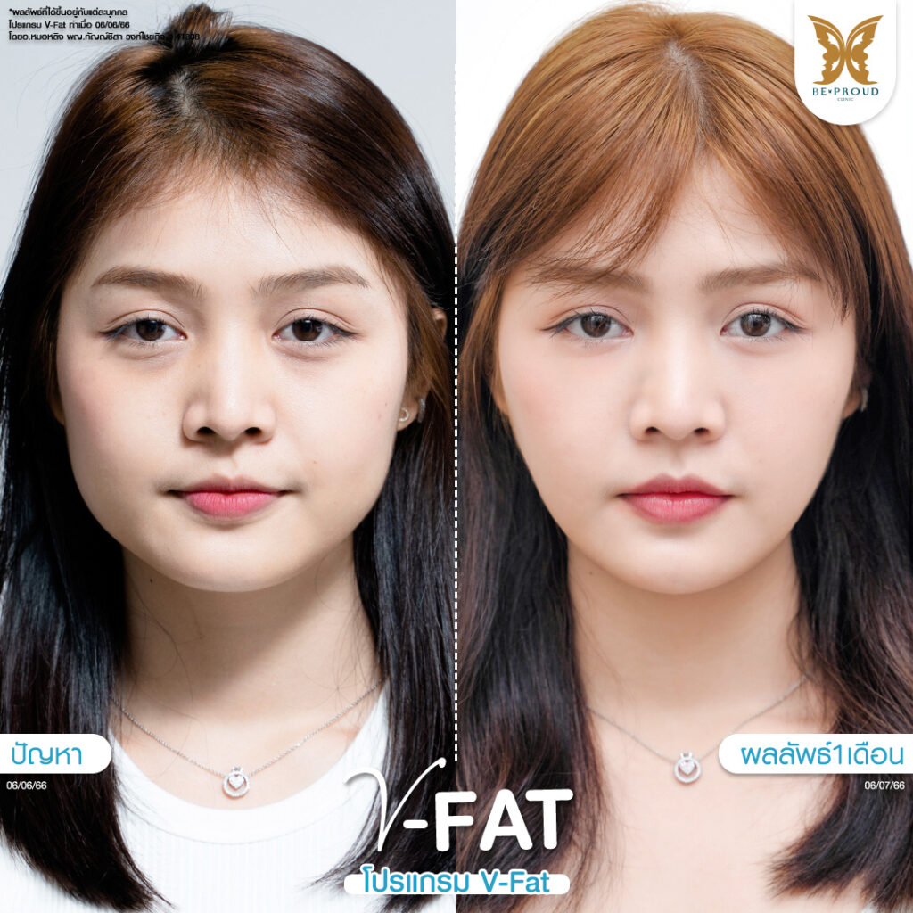 หัตถการปรับรูปหน้า​ V-Fat