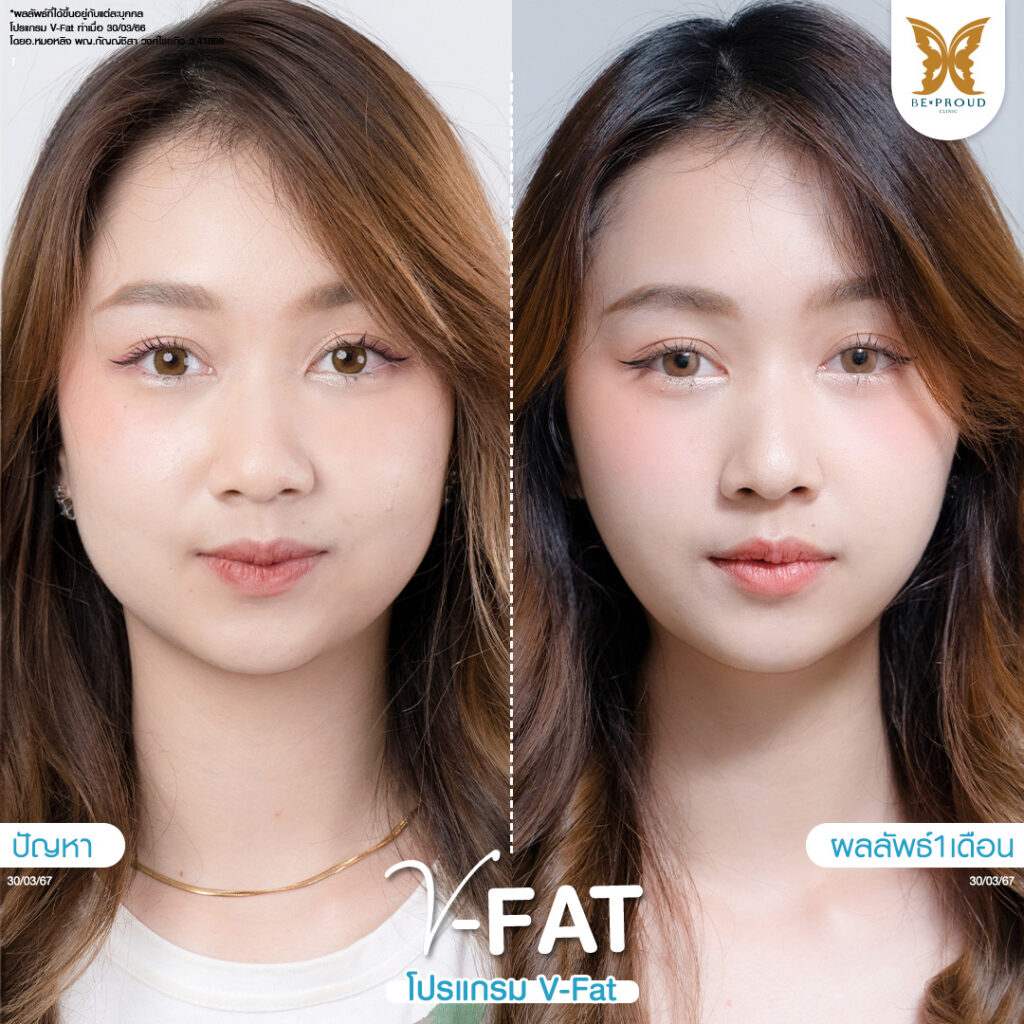หัตถการปรับรูปหน้า​ V-Fat