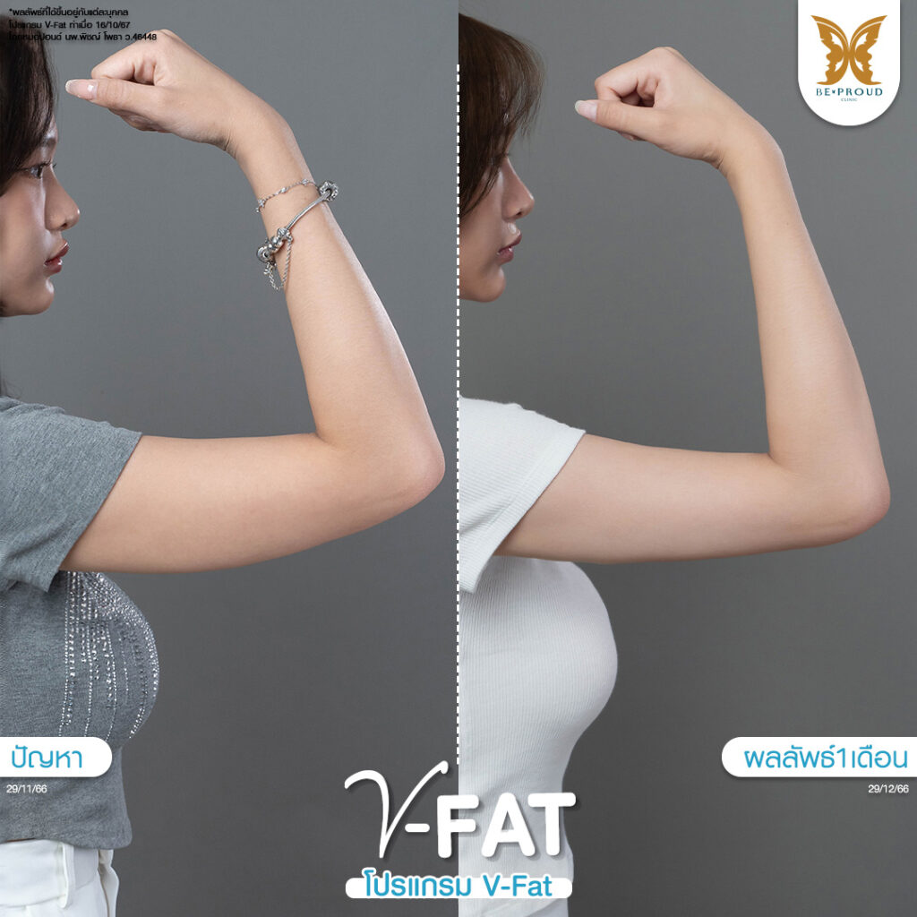 หัตถการ​ V-Fat แขน เหนียง