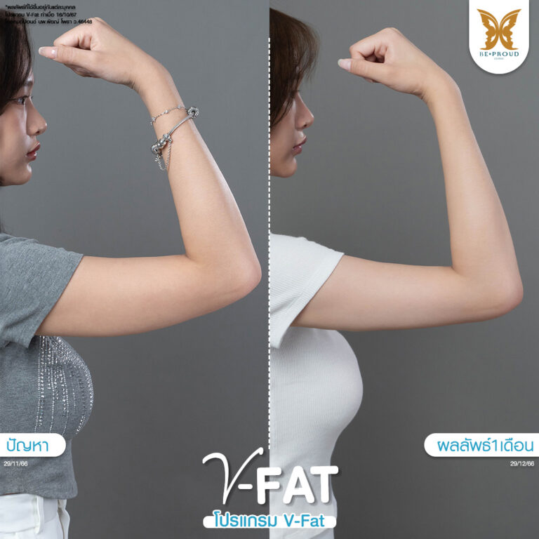 หัตถการ​ V-Fat แขน เหนียง