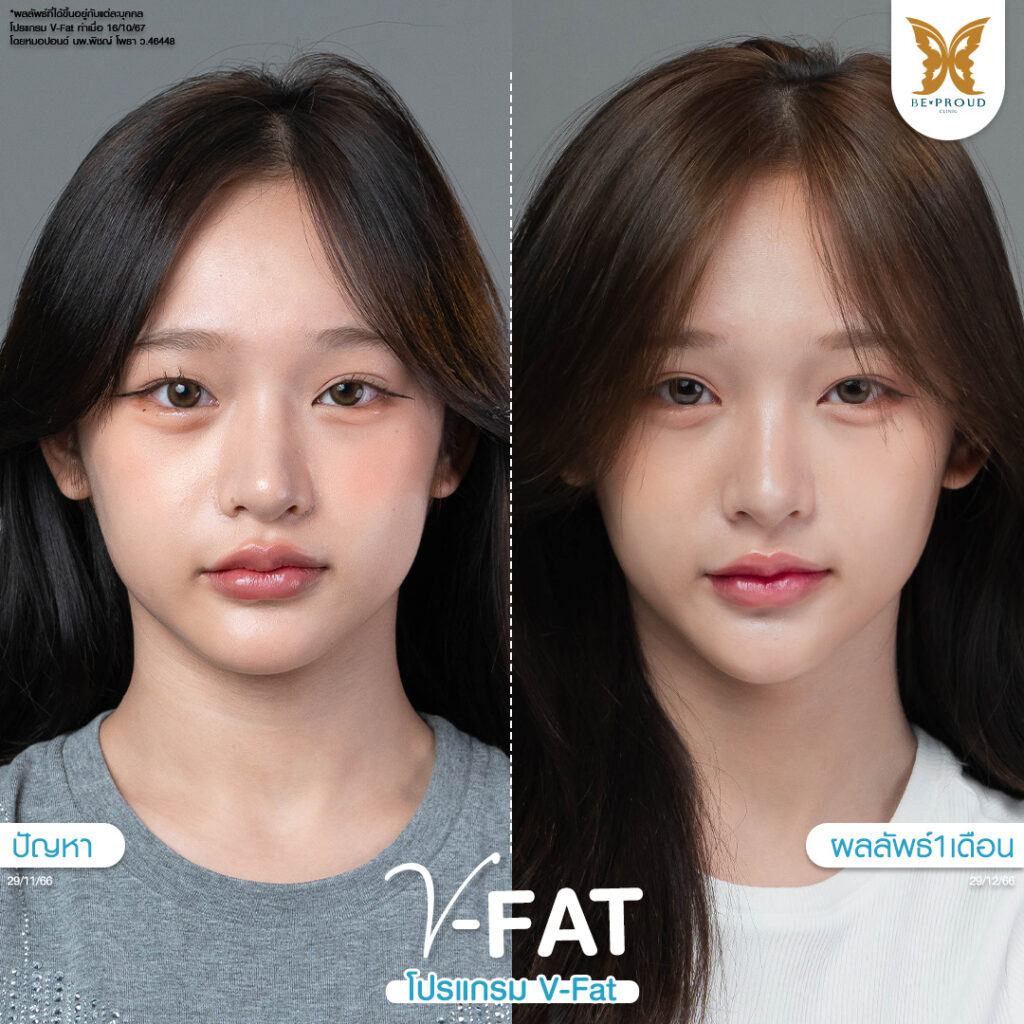 หัตถการปรับรูปหน้า​ V-Fat