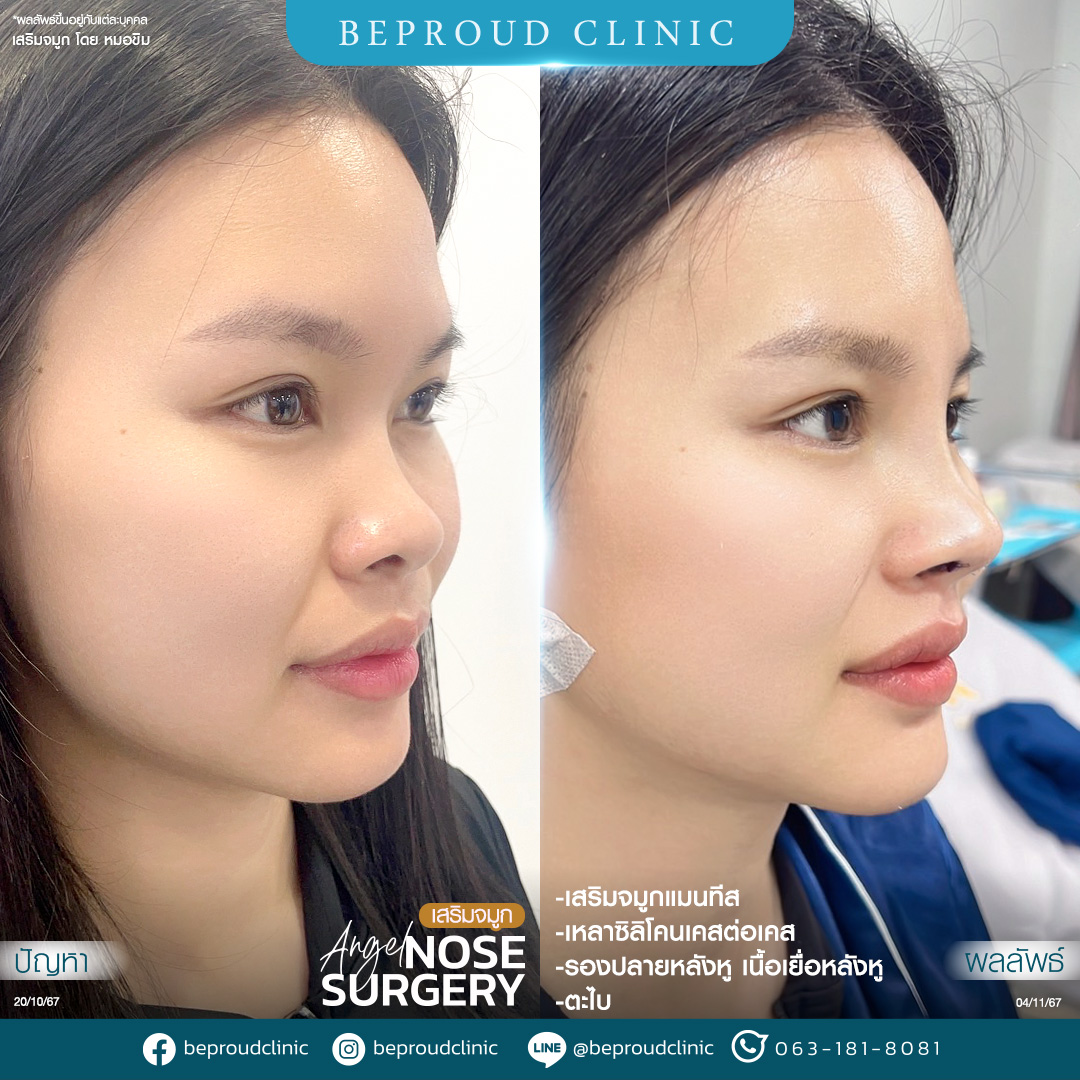 การรองปลายจมูกด้วยกระดูกอ่อนหลังหู