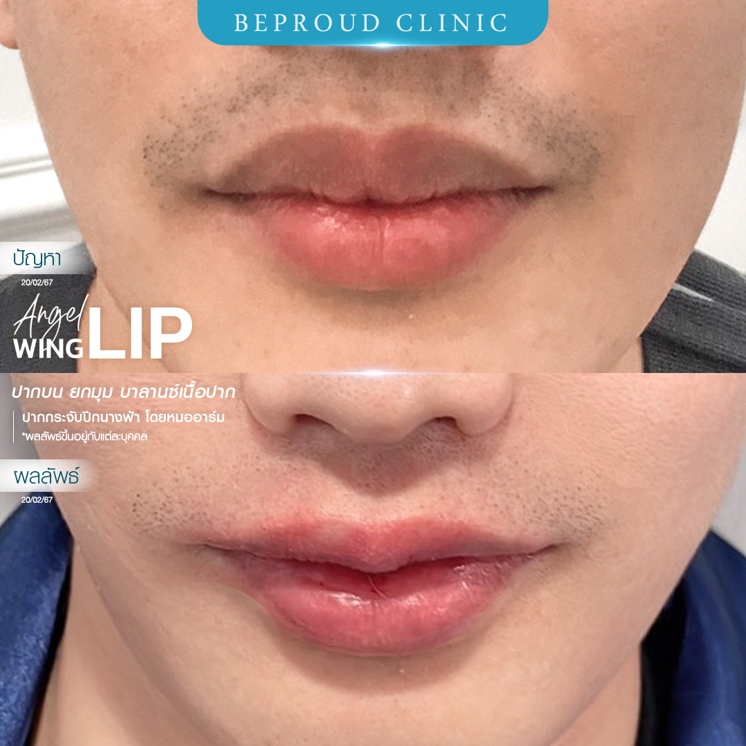 ปากกระจับผู้ชาย ทรงปากผู้ชาย ปากกระจับผู้ชาย ทําที่ไหนดี