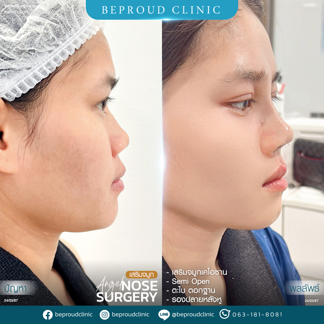 การรองปลายจมูกด้วยกระดูกอ่อนหลังหู