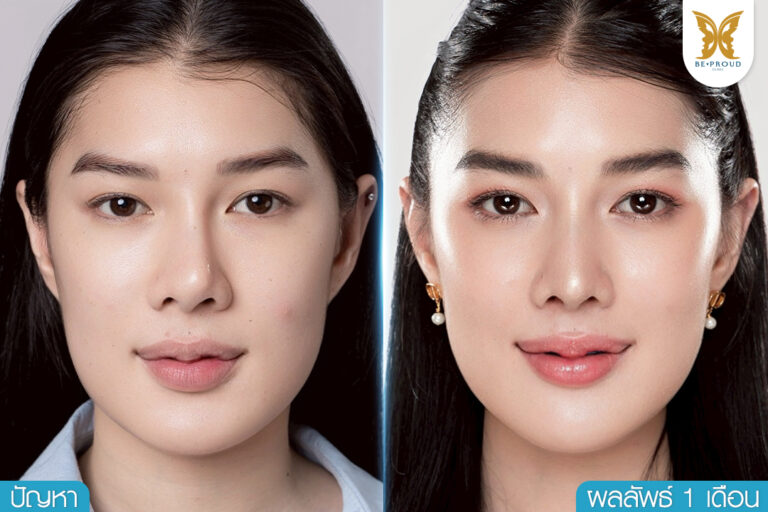 ภาพรีวิวแก้จมูกทรงธรรมชาติ แก้จมูกที่ไหนดี Before & After ที่บีพราวด์คลินิก เปรียบเทียบมุมด้านข้างก่อนทำ และผลลัพธ์ทันทีหลังทำที่ได้สันจมูกสโลปสวย ปลายพุ่ง มีมิติมากขึ้น