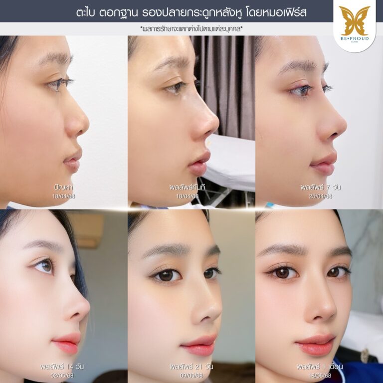 ภาพรีวิว แสดงไทม์ไลน์การฟื้นตัว 1 เดือน หลังศัลยกรรมจมูกเทคนิคตะไบฮัมพ์, ตอกฐาน และรองปลายด้วยกระดูกอ่อนหลังหู โดยหมอเฟิร์ส ที่บีพราวด์คลินิก เพื่อแก้ไขปัญหาจมูก