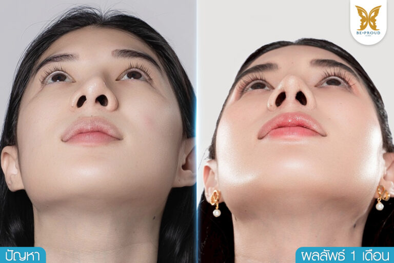 ภาพรีวิวแก้จมูกทรงธรรมชาติที่บีพราวด์คลินิก เปรียบเทียบมุมเงยก่อนและหลังทำ 1 เดือน แสดงให้เห็นปลายจมูกและรูจมูกที่สวยงามและได้รูปทรงมากขึ้น