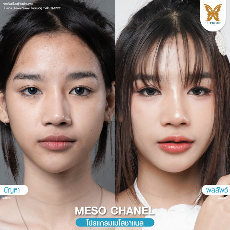 หัตถการผิวหน้าใส โปรแกรม Meso Chanel