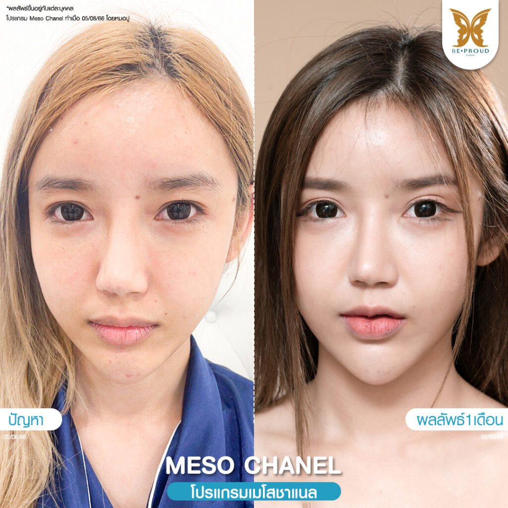 หัตถการผิวหน้าใส โปรแกรม Meso Chanel