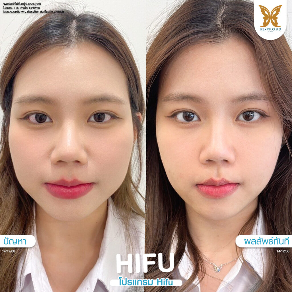 หัตถการปรับรูปหน้า ​HIFU