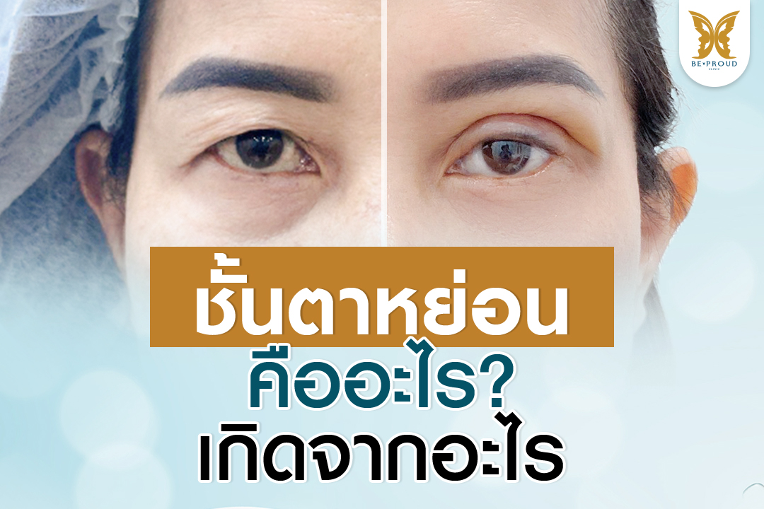 ชั้นตาหย่อนคล้อย , หนังตาตก , การผ่าตัดแก้ไขชั้นตา , การมองเห็น