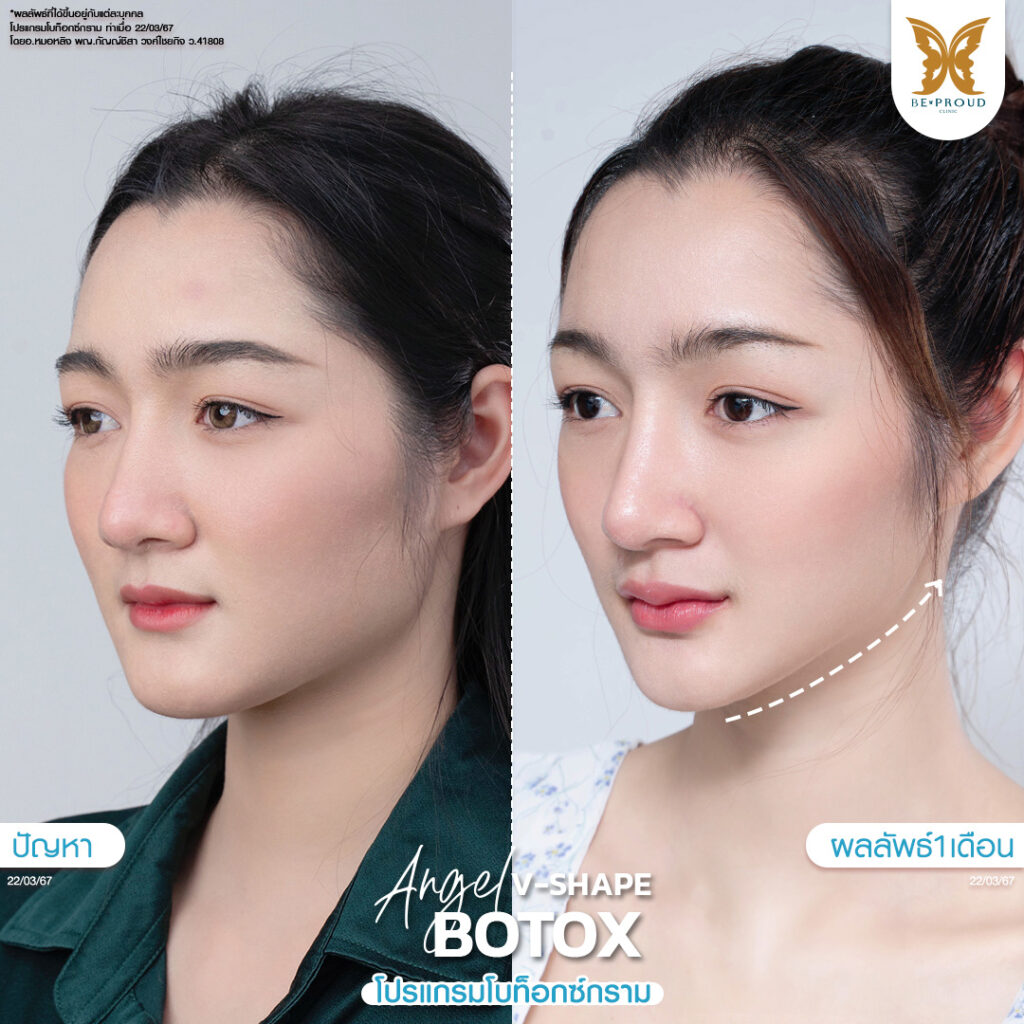 หัตถการ โบท็อกซ์กราม บีพราวด์