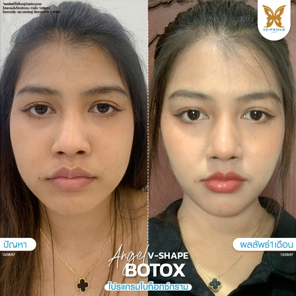 หัตถการ โบท็อกซ์กราม บีพราวด์