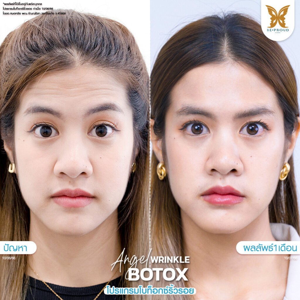 หัตถการ โบท็อกซ์ริ้วรอย บีพราวด์