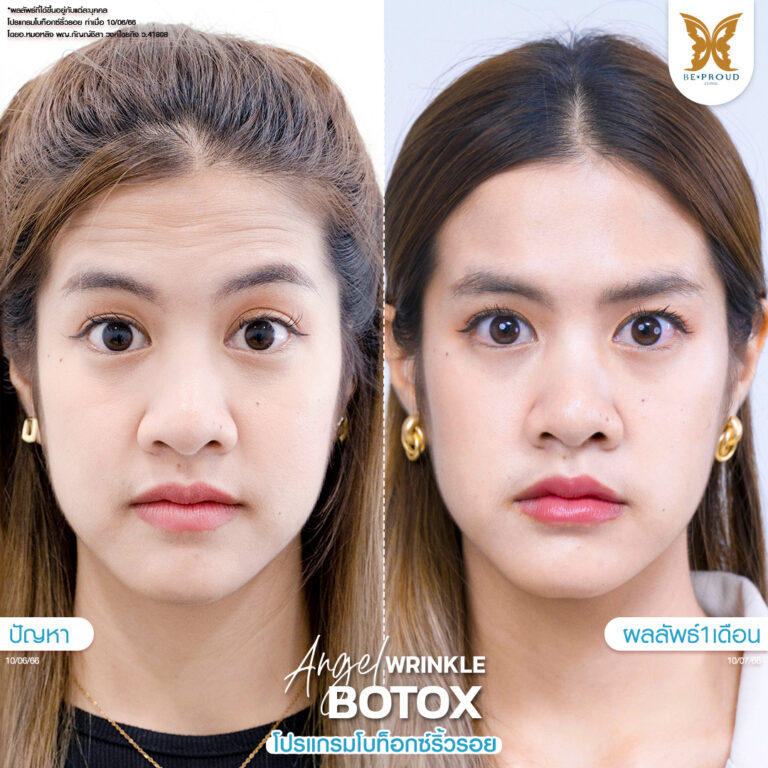 หัตถการ โบท็อกซ์ริ้วรอย บีพราวด์
