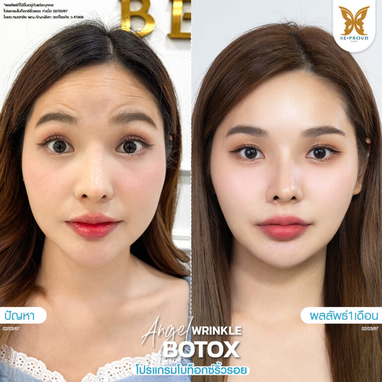 หัตถการ โบท็อกซ์ริ้วรอย บีพราวด์