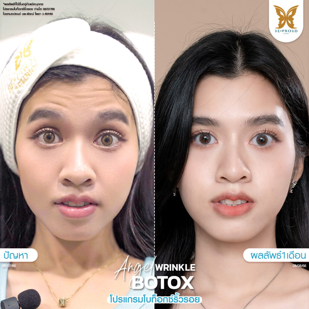 หัตถการ โบท็อกซ์ริ้วรอย บีพราวด์