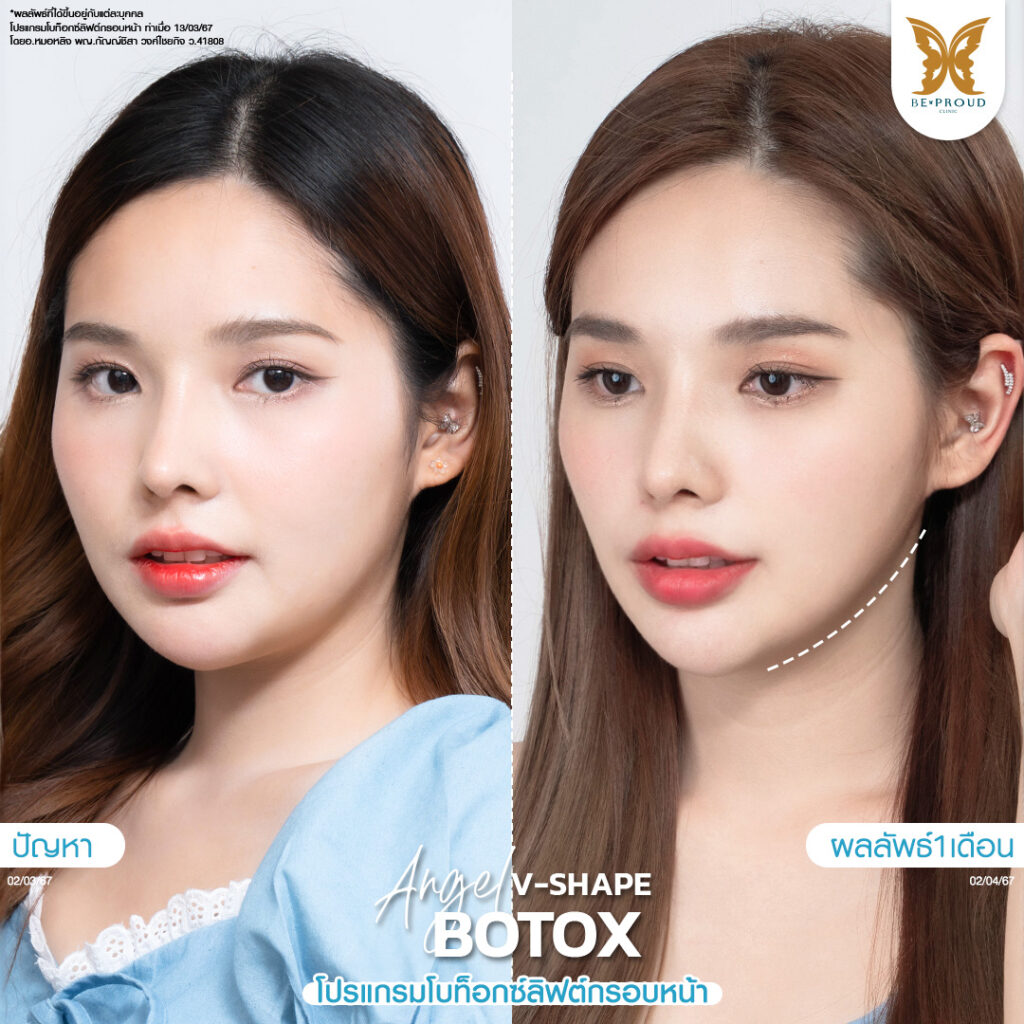 หัตถการ โบท็อกซ์ลิฟต์กรอบหน้า บีพราวด์