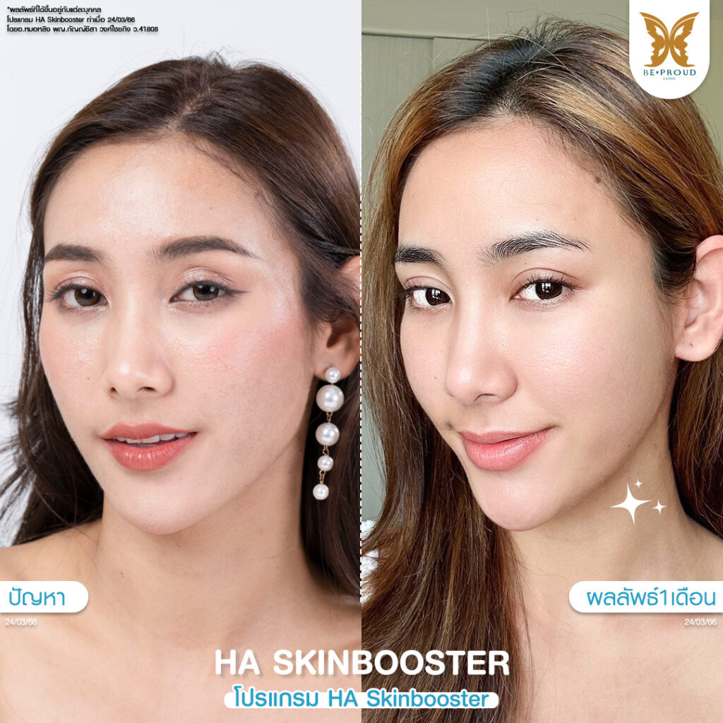 หัตถการผิวหน้าใส โปรแกรม HA Skin Booster