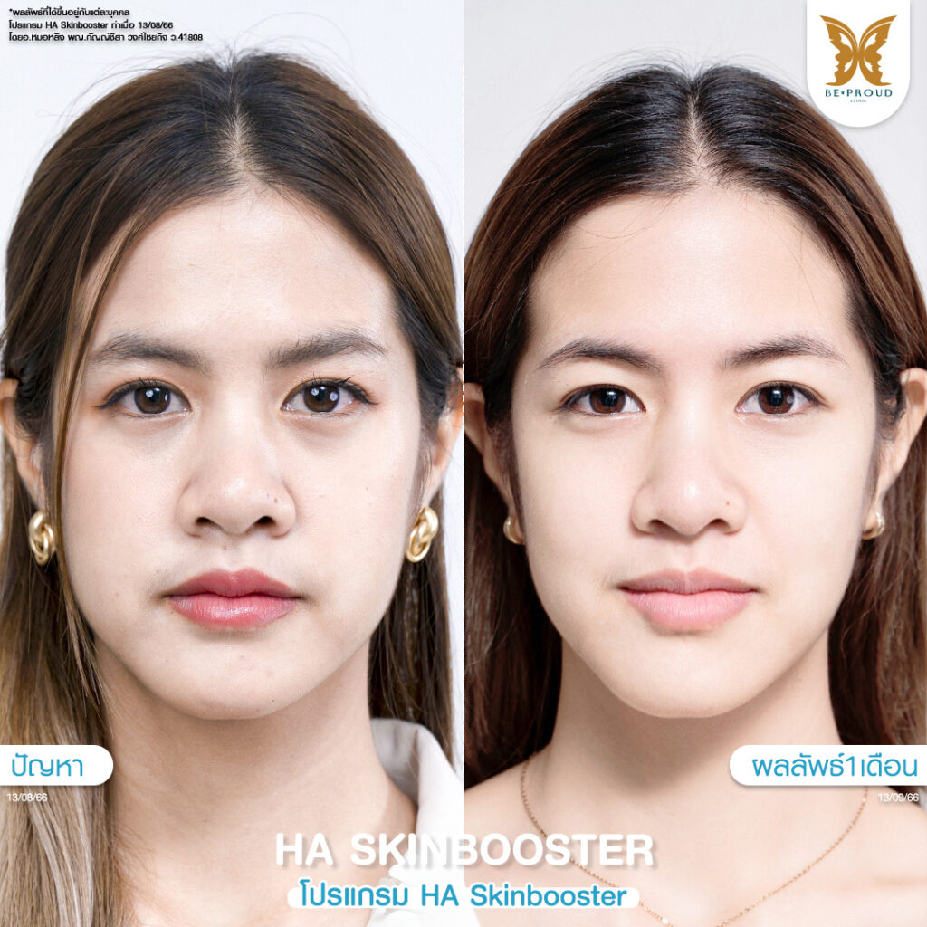 หัตถการผิวหน้าใส โปรแกรม HA Skin Booster