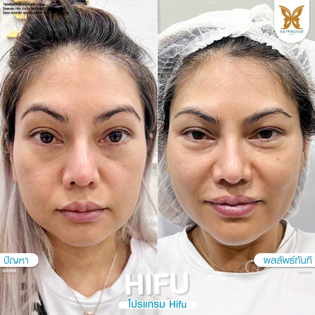 หัตถการปรับรูปหน้า ​HIFU