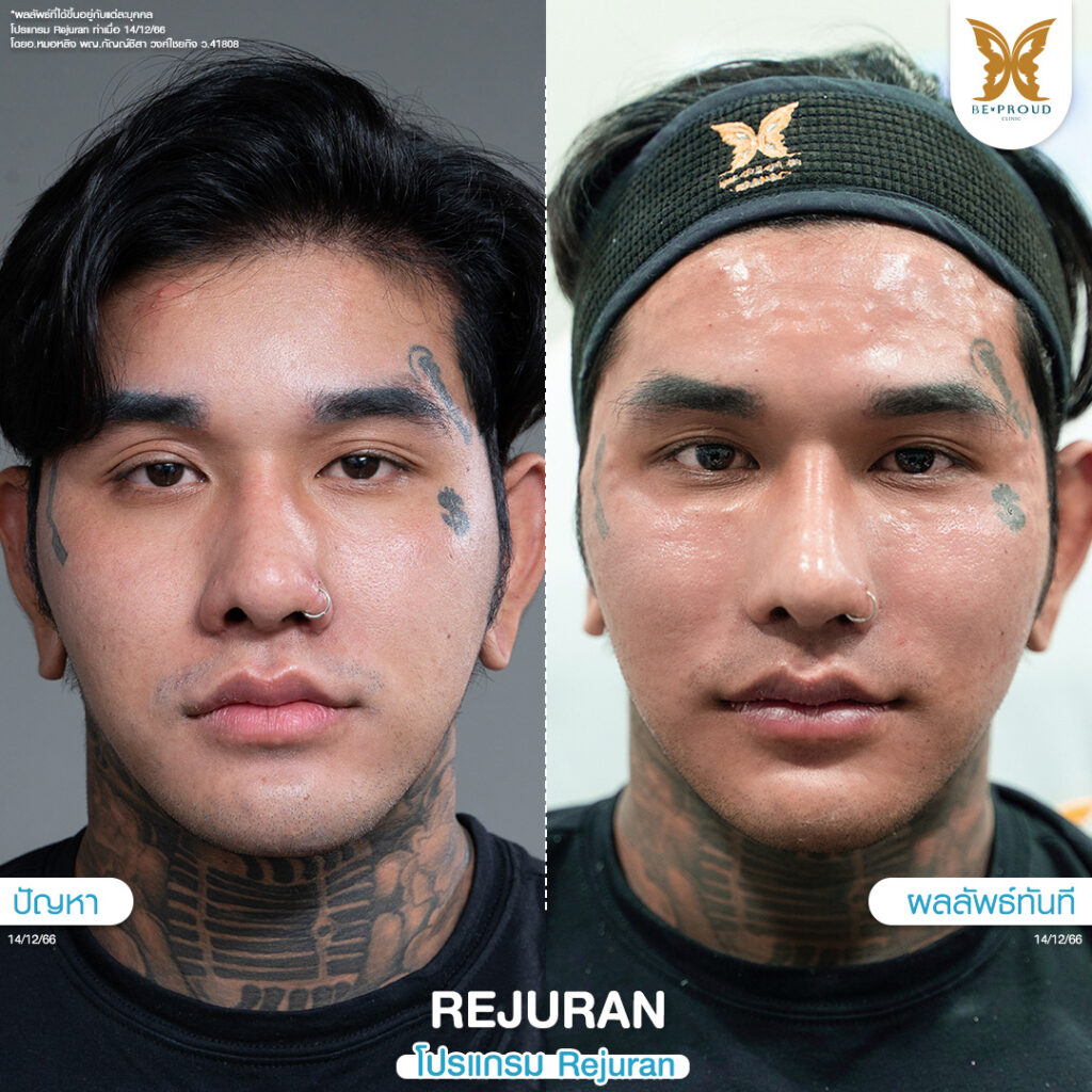หัตถการผิวหน้าใส โปรแกรม Rejuran