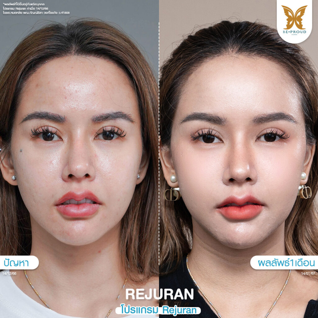 หัตถการผิวหน้าใส โปรแกรม Rejuran