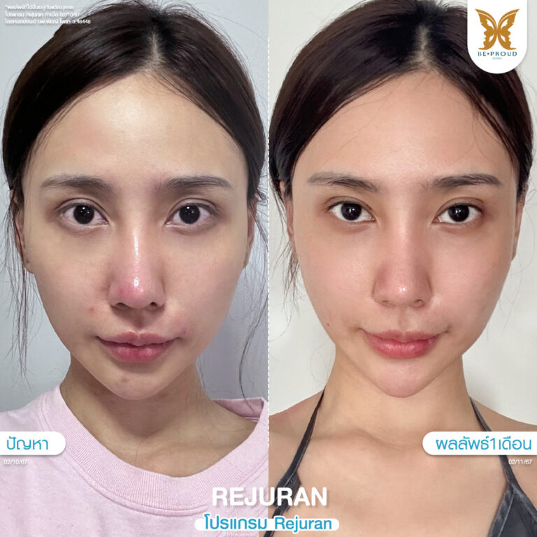 หัตถการผิวหน้าใส โปรแกรม Rejuran จากผิวแพ้ง่ายสู่ผิวสุขภาพดี ภาพเปรียบเทียบก่อน-หลังทำรีจูรัน 1 เดือนที่บีพราวด์คลินิก ดูแลโดยหมอปอนด์ นพ.พิชญ์ โพธา