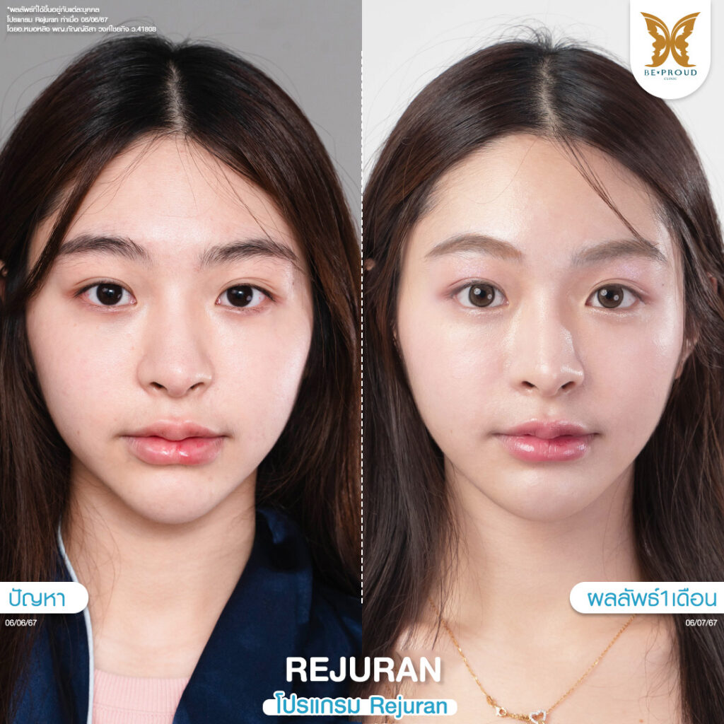 หัตถการผิวหน้าใส โปรแกรม Rejuran