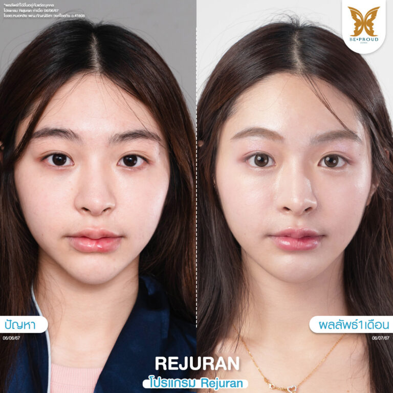 หัตถการผิวหน้าใส โปรแกรม Rejuran