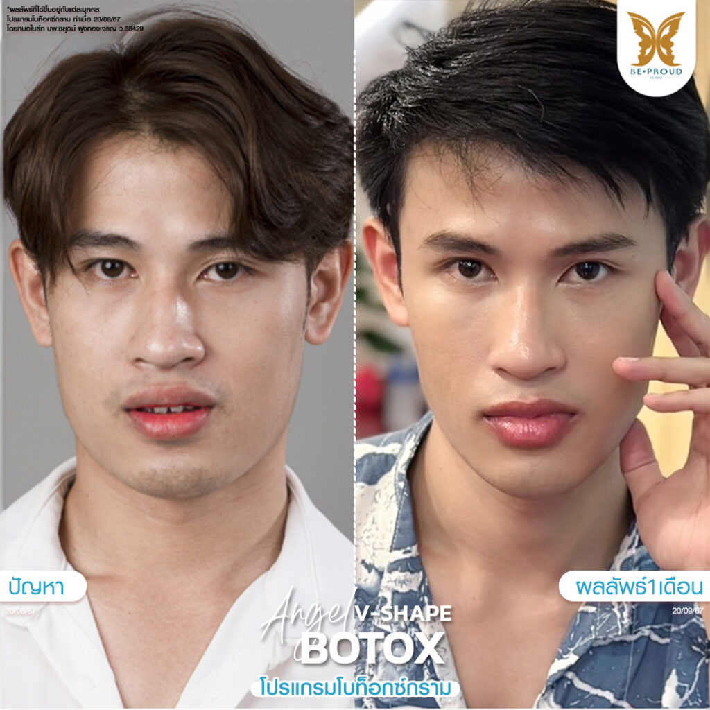 หัตถการ โบท็อกซ์กราม บีพราวด์