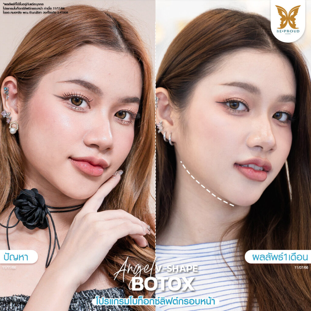 โบท็อกซ์ลิฟต์กรอบหน้า บีพราวด์