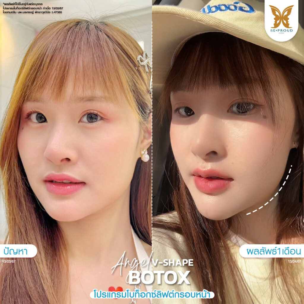 โบท็อกซ์ลิฟต์กรอบหน้า บีพราวด์