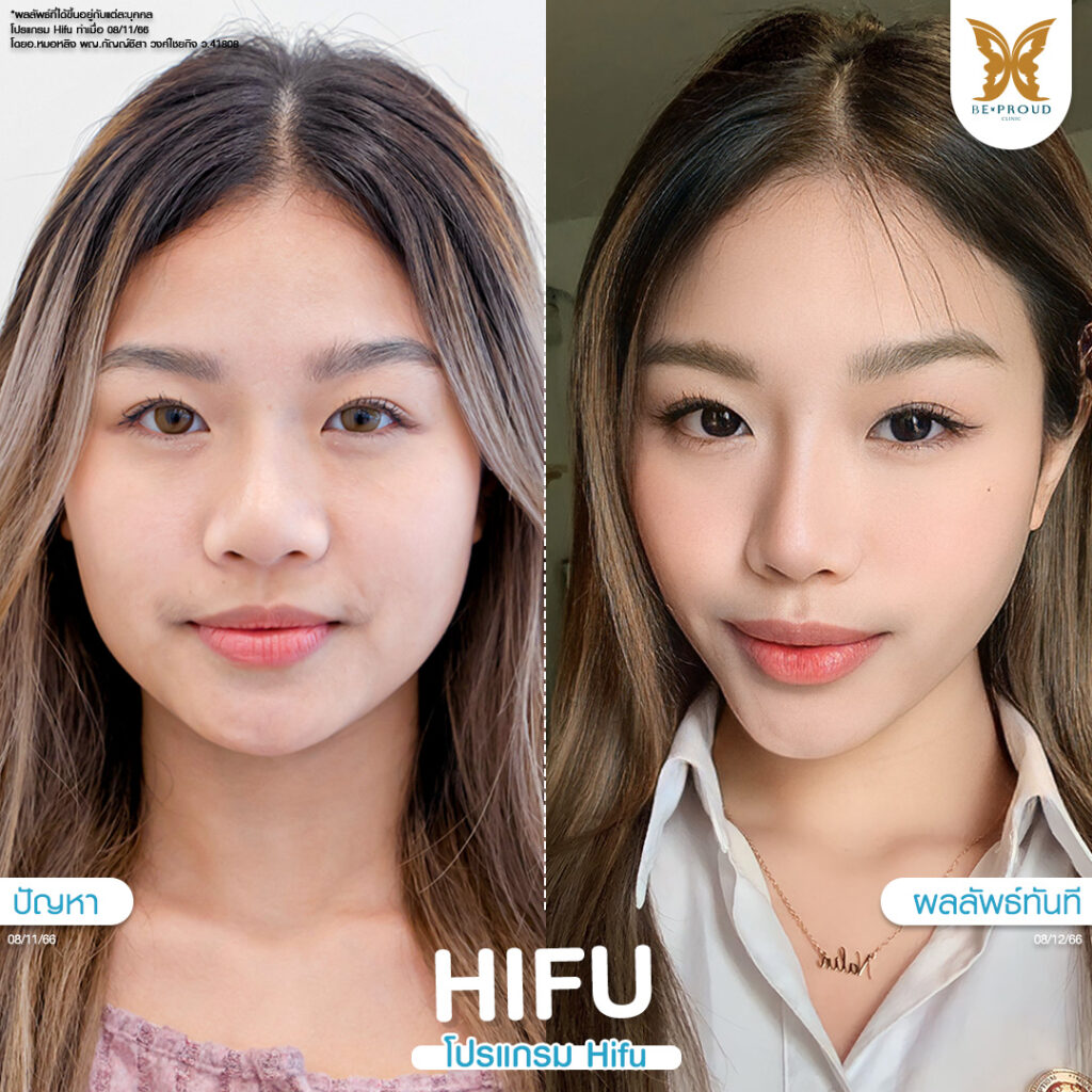 หัตถการปรับรูปหน้า HIFU