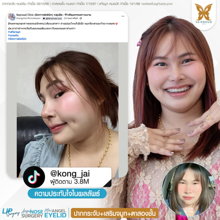 รีวิวความประทับใจศัลยกรรมปากกระจับ เสริมจมูก และตาสองชั้น คุณ @kong_jai แสดงภาพก่อนทำและหลังทำศัลยกรรม กับหมอขิม หมอนัตโตะ หมอดา ที่บีพราวด์คลินิก