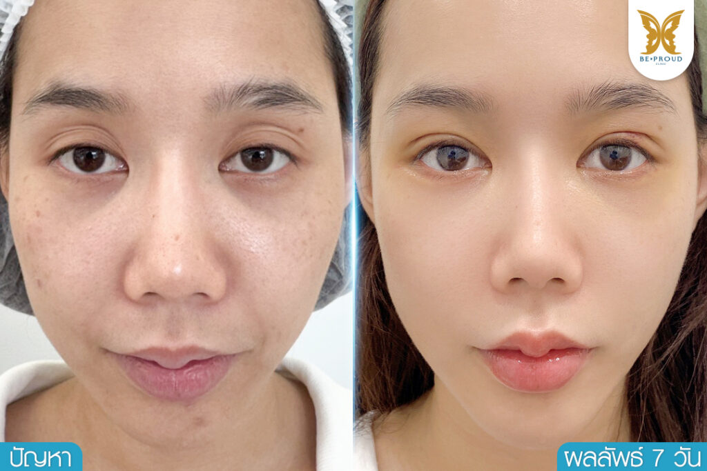ภาพรีวิว Before & After ศัลยกรรมตาสองชั้นแก้ปัญหาตาลึกโหล เบ้าตาลึก เติมไขมันเบ้าตาลึก ที่บีพราวด์คลินิก แสดงให้เห็นดวงตาที่ดูอิ่มฟูและสดใสขึ้นทันทีหลังทำ