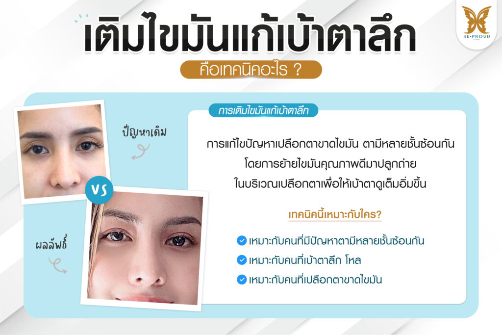 ภาพประกอบบทความ เทคนิคเติมไขมันแก้เบ้าตาลึก เปรียบเทียบภาพก่อนและหลังศัลยกรรม พร้อมคำอธิบายเทคนิคศัลยกรรม