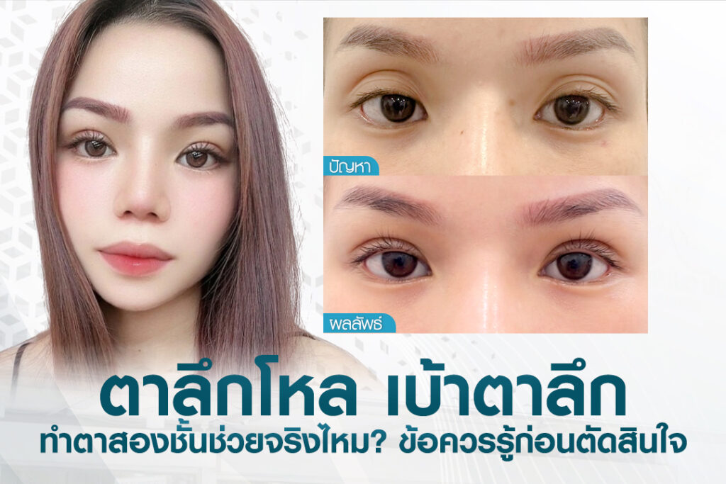 ภาพศัลยแพทย์ผู้เชี่ยวชาญที่บีพราวด์คลินิกกำลังประเมินและให้คำปรึกษาแก่คนไข้ที่มีปัญหาเบ้าตาลึก ตาลึกโหล เพื่อวางแผนการทำตาสองชั้นและเติมไขมันเบ้าตา