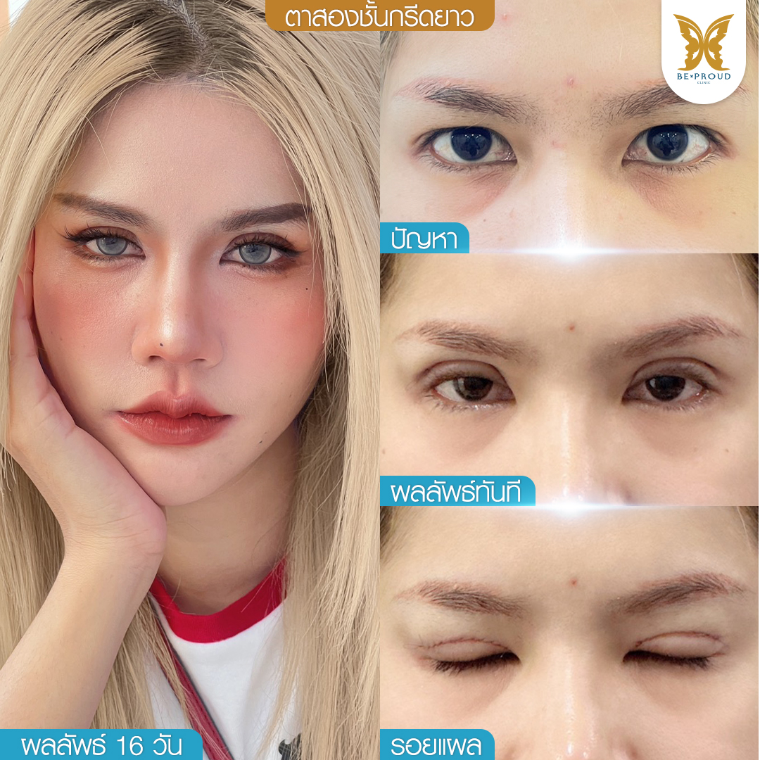 ตาสองชั้น, ทำตาสองชั้น , ปัญหาชั้นตา , ความสวยงาม