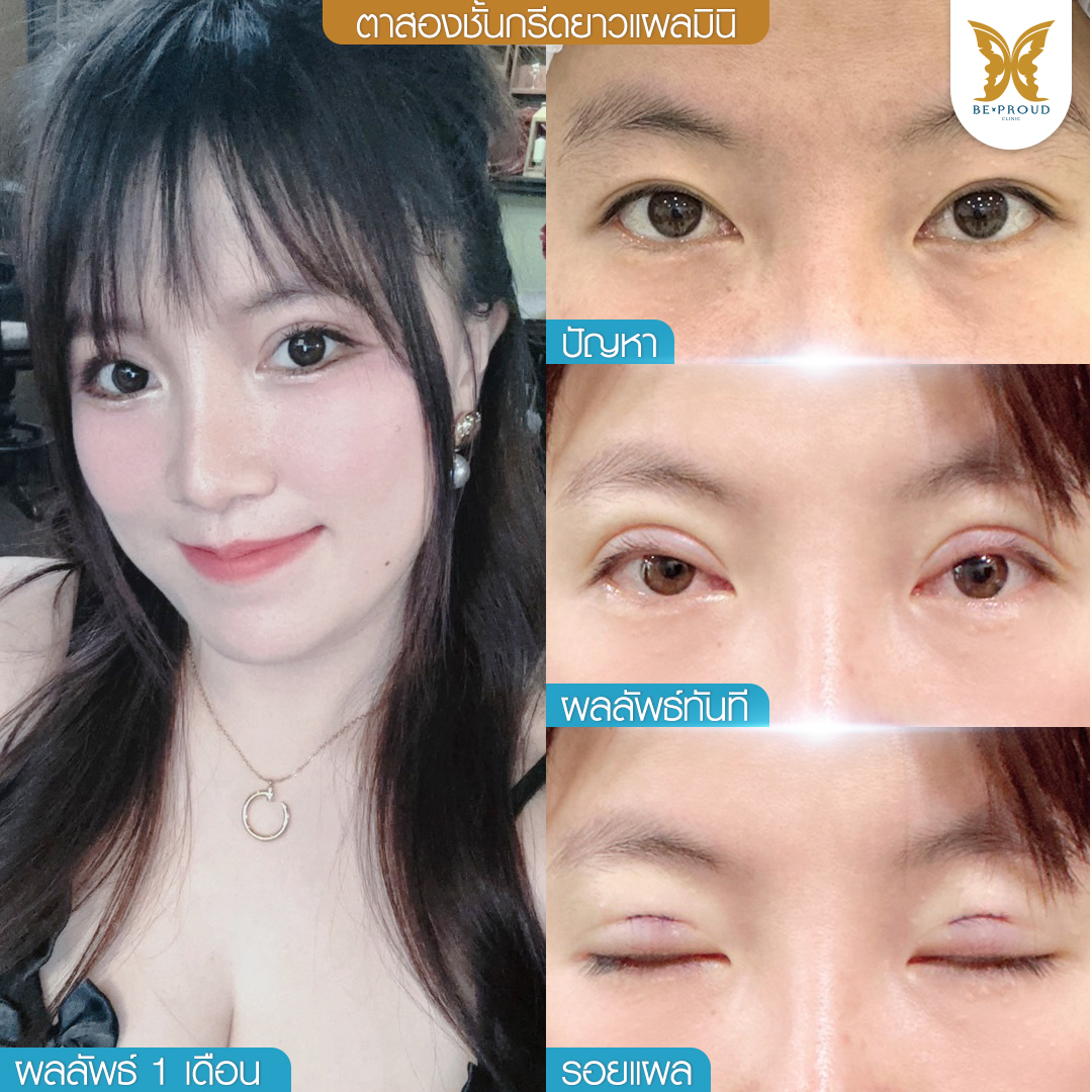 ตาสองชั้น, ทำตาสองชั้น , ปัญหาชั้นตา , ความสวยงาม